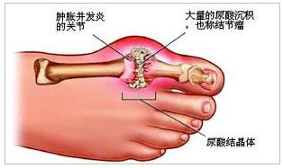 (足痛风示意图)